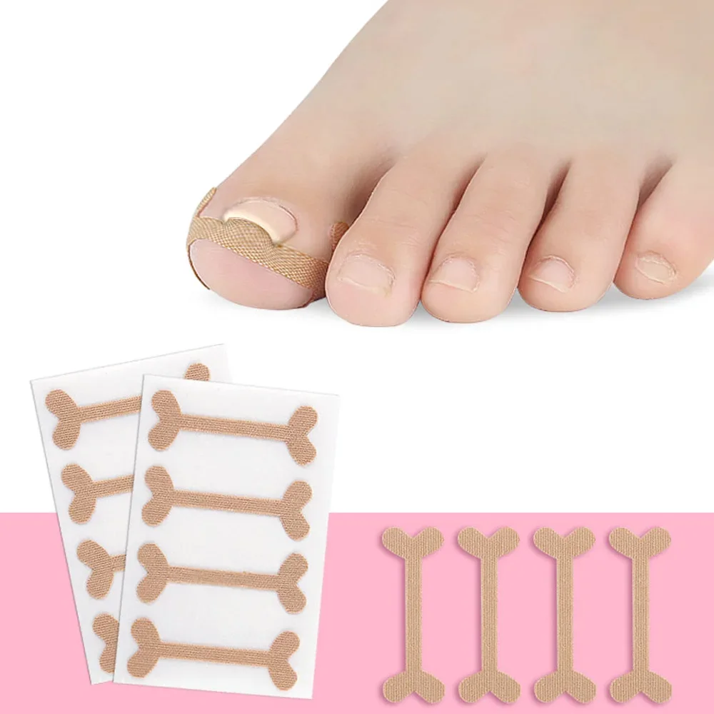 Tcare 1Set Toe Nail Groove Foot Nail Orthodontic Device Thumb Nail Patch Quick Pedicure Toe Nail Deformation Recover Foot Care