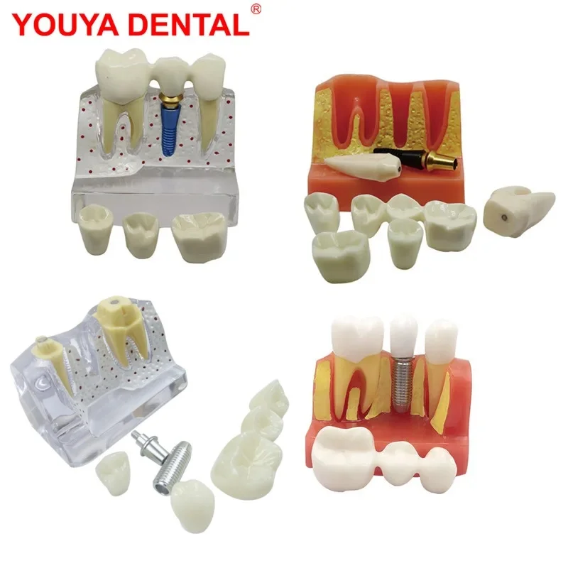 

Dental Model Teeth Teaching Model Removable Resin Implant Tooth Models For Dentistry Dentist Analysis Crown Bridge Demo Studying