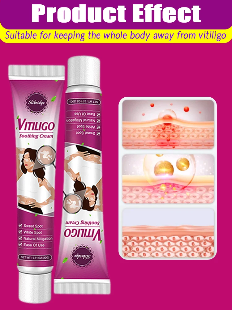 Crema para manchas blancas de Vitiligo, crema para manchas blancas, Leukoplakia, pigmentación, melanina, promueve el Vitiligo, cuidado de la piel