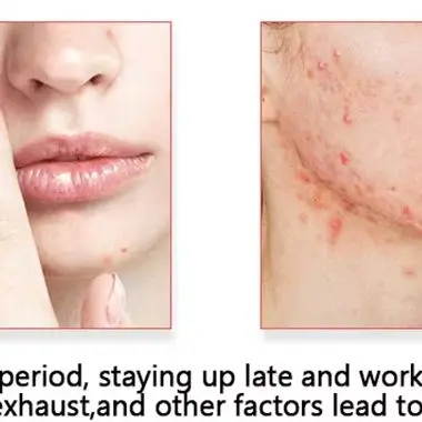 200 unids/set de pegatinas de acné de dibujos animados de colores mezclados, pegatinas circulares en forma de estrella en forma de corazón, herramientas para el cuidado de la piel y el maquillaje Facial