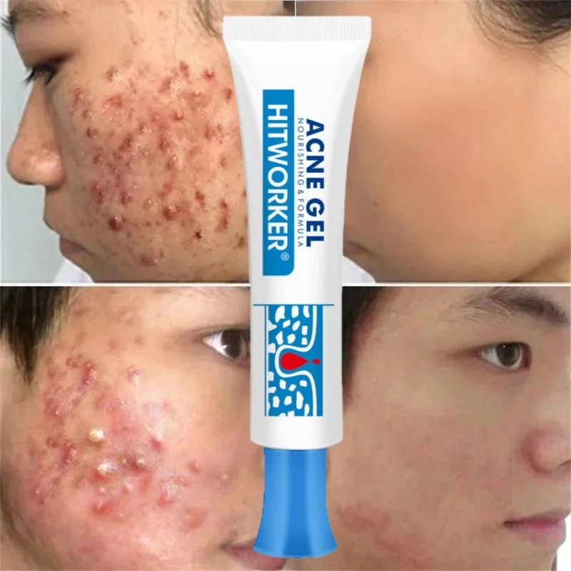 Salicylic Acid Acne Removal Cream Anti-Acne Repair Redness Pimple Spots Deep Cleaning Pore Oil Control Moisturizing Skin Care image 2
