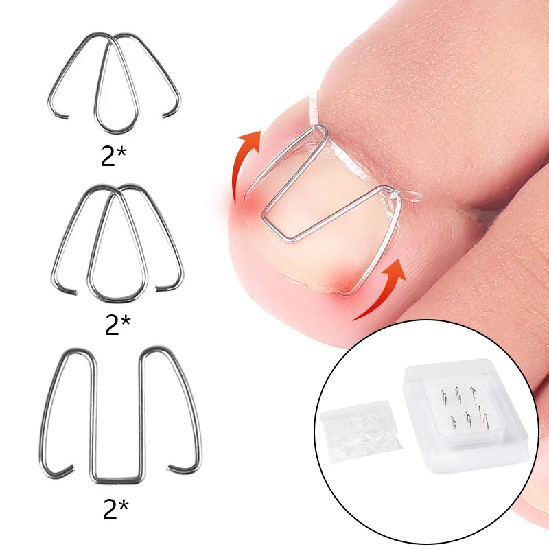 Ingrown Toenail Corrector Foot Care Tools Wire Straightening Clips Toenail Correction Tools Toenail Fixer Hook For Toenail