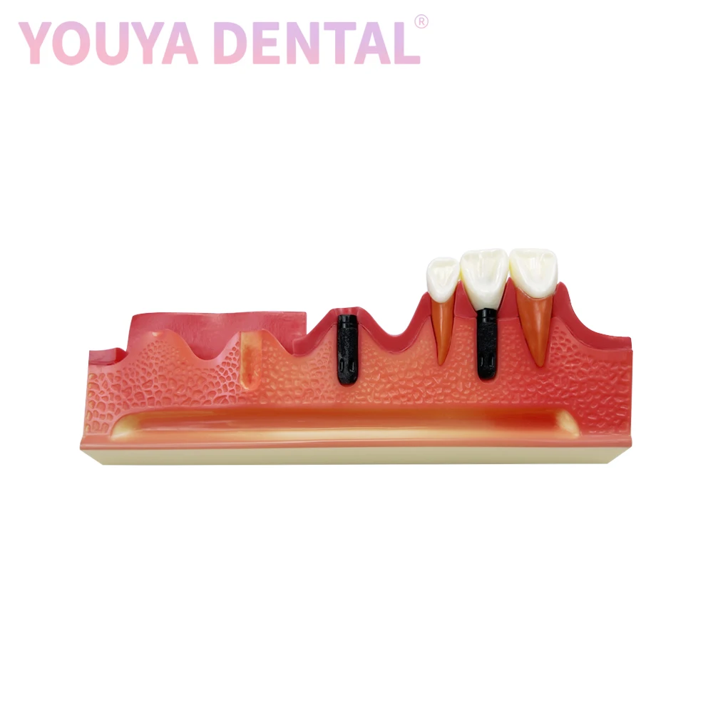 Dental Typodont Dental Implant Model Denture Implantation Step Process Is Suitable For Dentists Demonstration Teaching Training