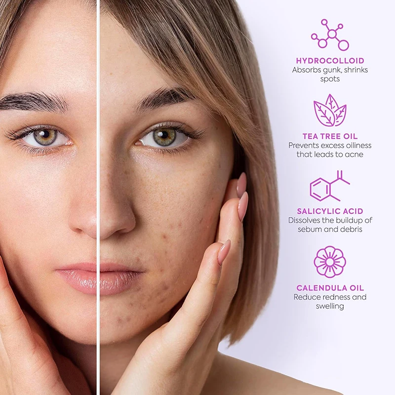 128 قطعة/المجموعة بثرة التصحيح حب الشباب الملونة غير مرئية حب الشباب إزالة العناية بالبشرة ملصقات المخفي الوجه بقعة الجمال #5