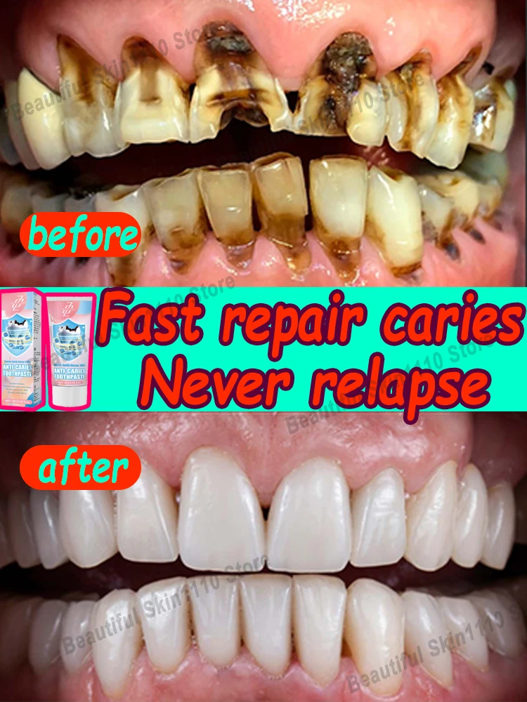 Caries ʏ ʀᴇᴄᴜᴘᴇʀᴀᴄɪᴏ́ɴ ᴅᴇ caries Rᴇɢᴇɴᴇʀᴀᴄɪᴏ́ɴ ᴅᴇʟ ᴇsᴍᴀʟᴛᴇ