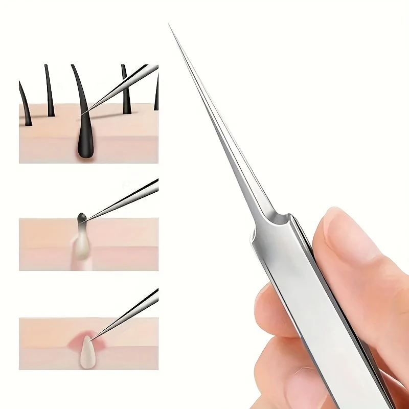 極細No.1パック 5 つの細胞ニキビにきびピンセット - 顔の美しさを除去するニキビ針ツール、スキンケア用