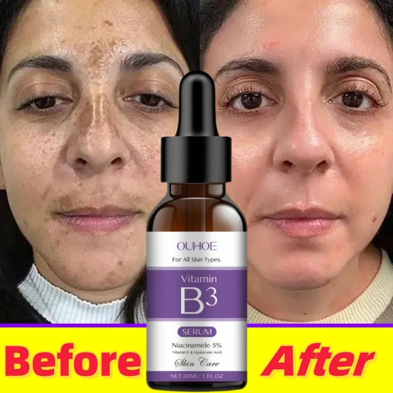 

Сыворотка для лица с витамином B3 Ниацинамид 5% Vitanin E Гиакуроновая кислота Удаление черных пятен Веснушки Выцветание Меланин Пигментация Осветление