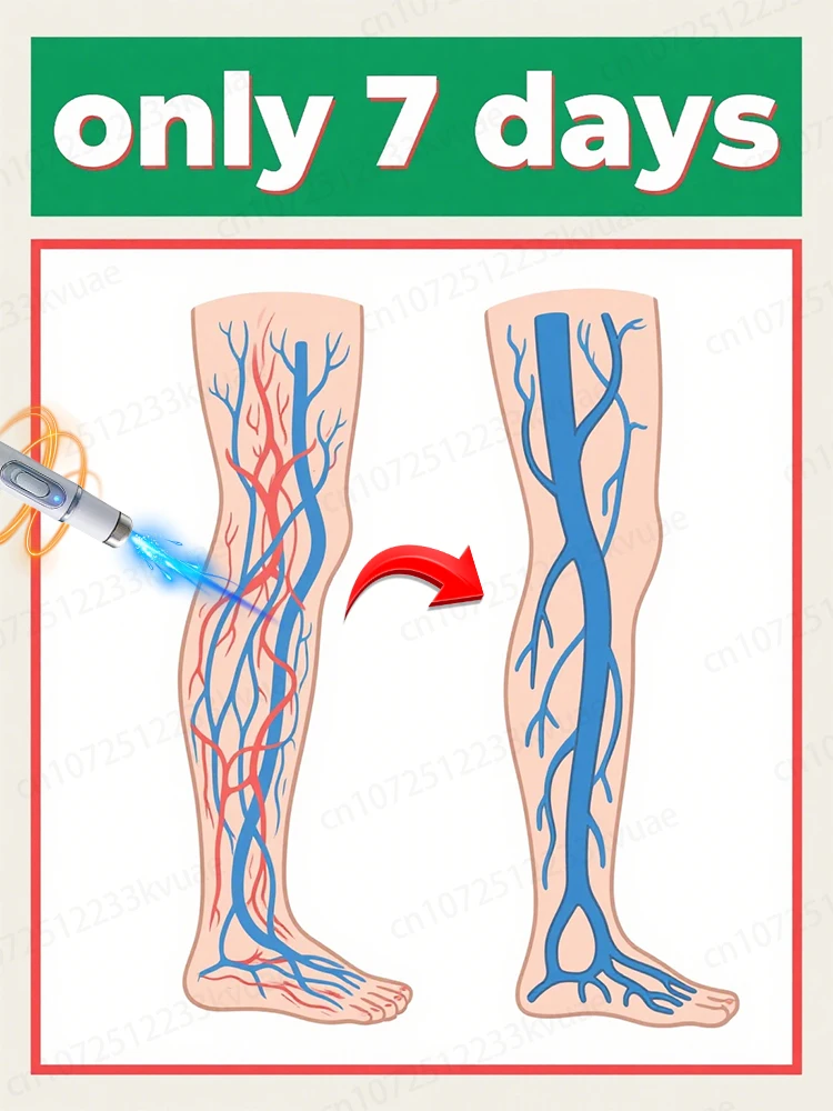 

Generation-8 Laser Says Goodbye To Spider Legs Varicose In 3 Days
