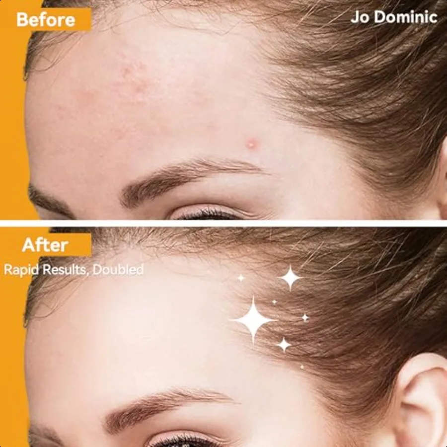 MAGIX PATCH Large Invisible Acne Patches by Hydrocolloid Big Forehead Pimple Patches Zit Patches for Face Absorbs Oil Zits Blem