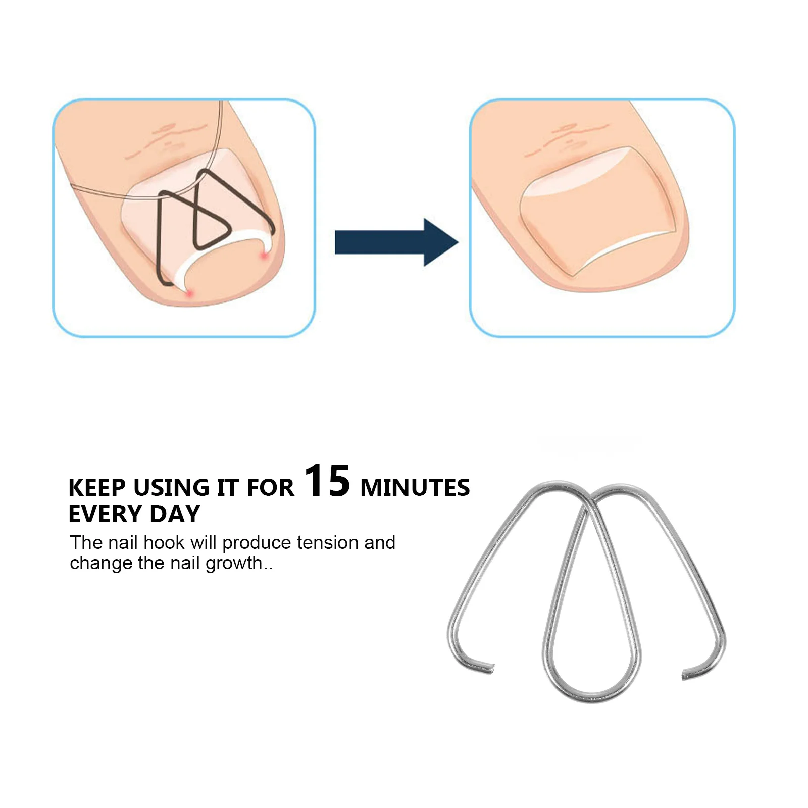 

Correction Hook Pedicure Tools Paronychia Stroller Nail Straightening Corrector