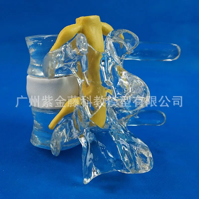 Anatomical Human Lumbar Vertebrae Skeleton Anatomy Degenerative Lumbar Disc Herniation Demonstration Model Spine Medical Aids