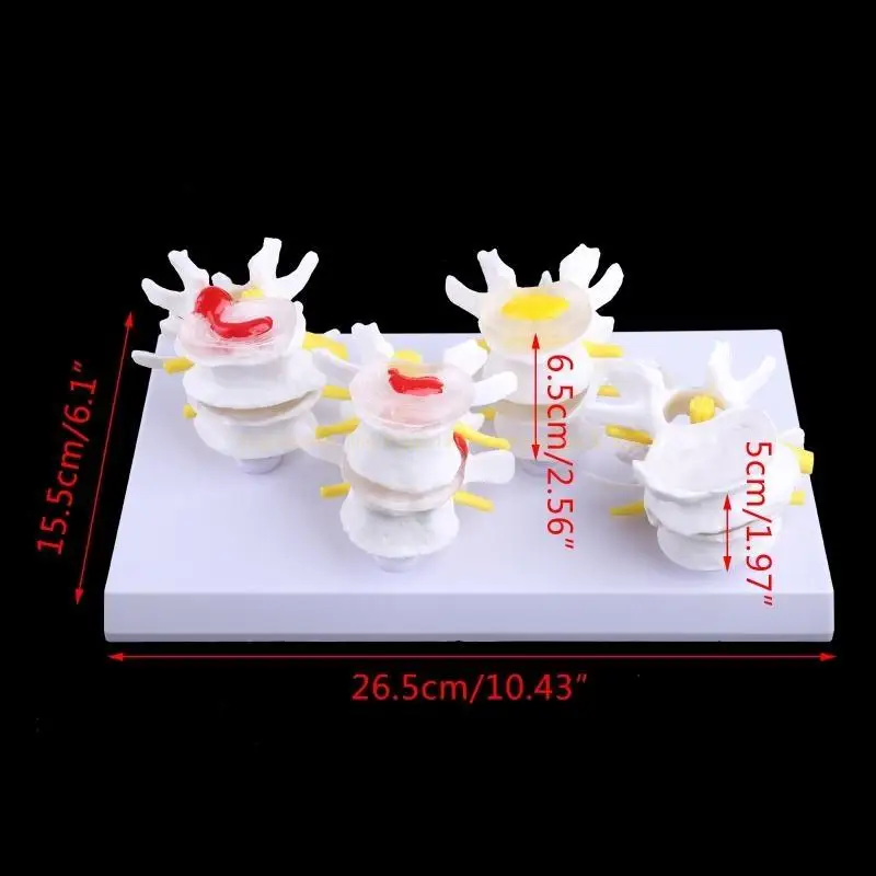 1 Set Human Lumbar Lesion Spine Statue Display Model Medical Teaching Learning f