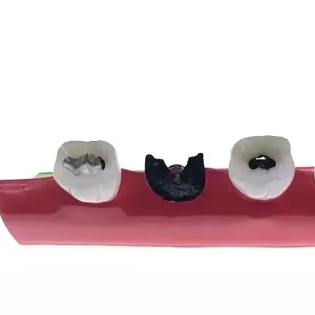 

Dental Caries Classify Tooth Model Pathological Process & Caries Evolution Decayed Model Dentist Lab Teaching Tool