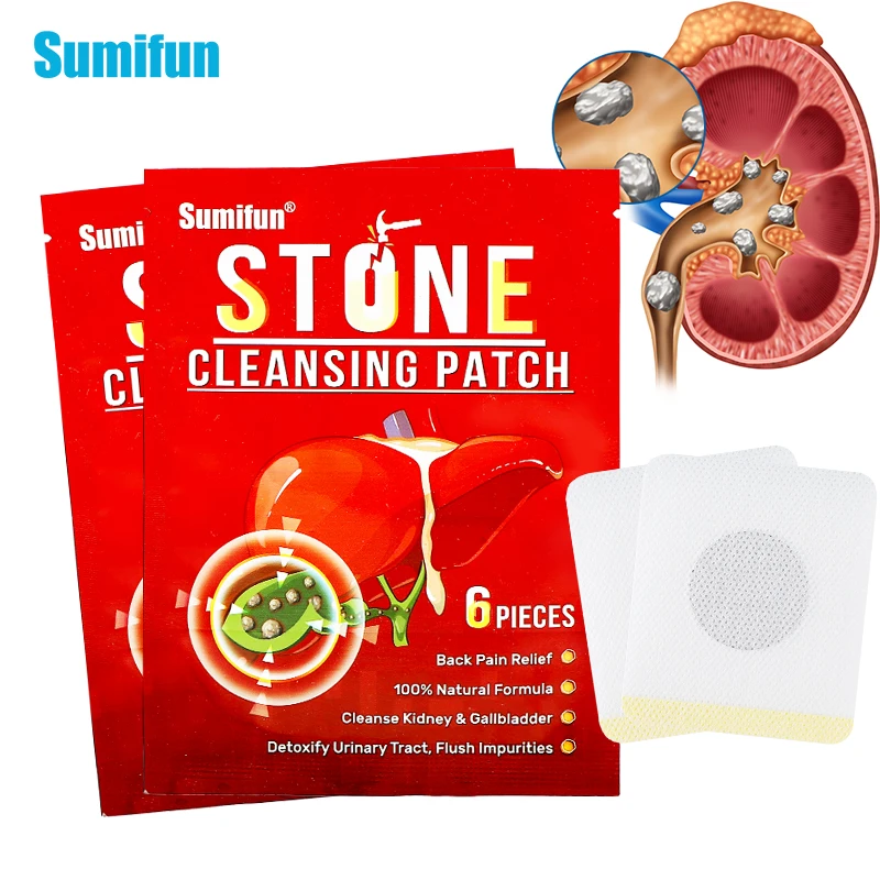 Sumifun 6pcs Gallstones Treatment Patch Remove Kidney Stone Urolithiasis Plaster Renal Calculus Chinese Medicines Health Care