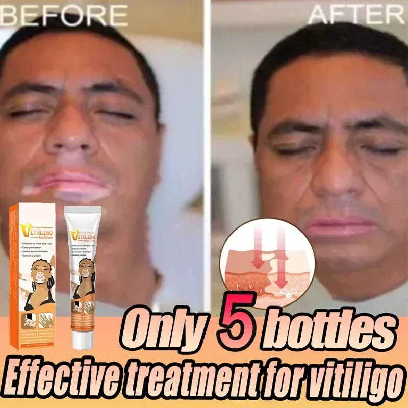 Vitiligo cream Vitiligo derma relief Skin soothing White Spot Removal vitiligo ointment Eliminate pigment