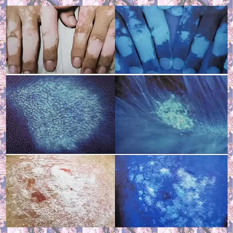 L73A 2025-3X lámpara de madera analizador de piel analizador de belleza de salón Facial portátil lámpara de madera UV para pruebas de análisis de cuidado de la piel