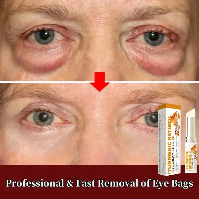 Eye Bag Fast Remove Eye Cream Fat Particles Dark Circles Puffiness Fade Fine Lines Lift Brighten Beauty Eye Care Stick