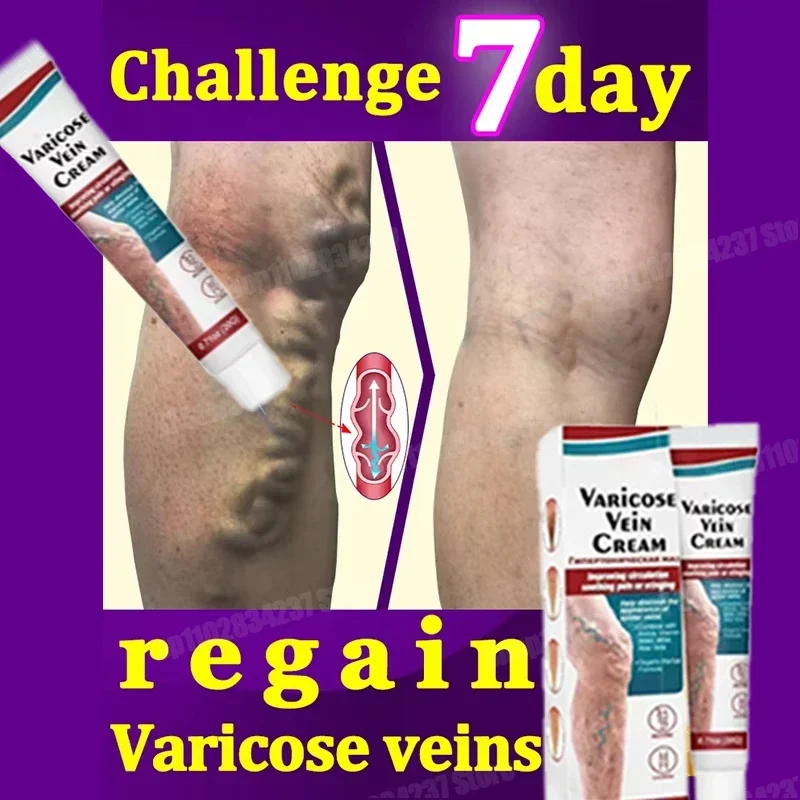 Varicose veins effectively alleviate lower limb vasculitis and improve circulation in patients with venous inflammation 1