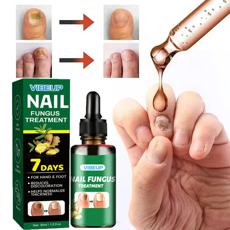 7 Dagen Nagel Schimmel Behandeling Serum Gember Anti-infectieuze Paronychia Onychomycose Teen Voet Nagel Schimmel Reparatie Gel Hand Voetverzorging