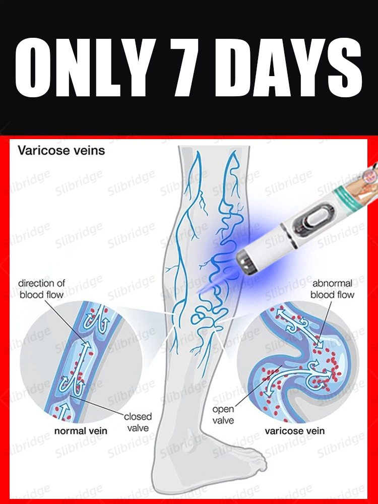 

Vein blue light tool, more discounts on sets