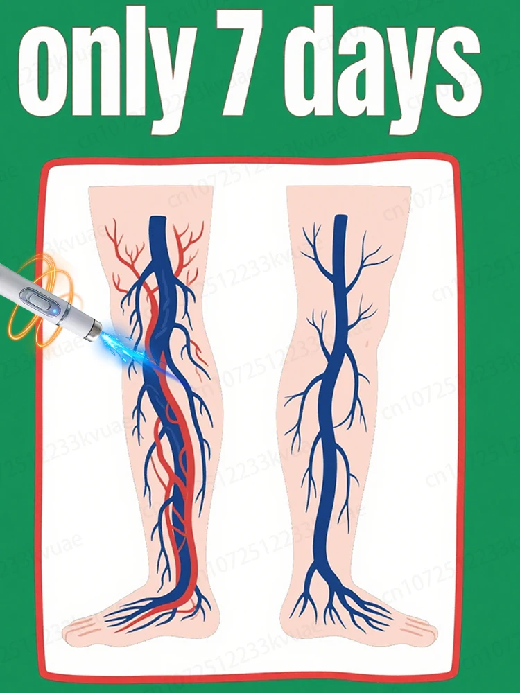 

Generation-8 Laser Says Goodbye To Spider Legs Varicose In 3 Days