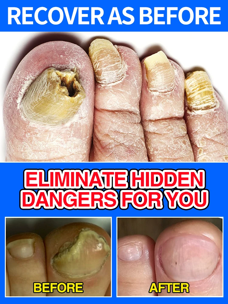 

Portable nail cleaning equipment, professional nail laser irradiation, nail accessories