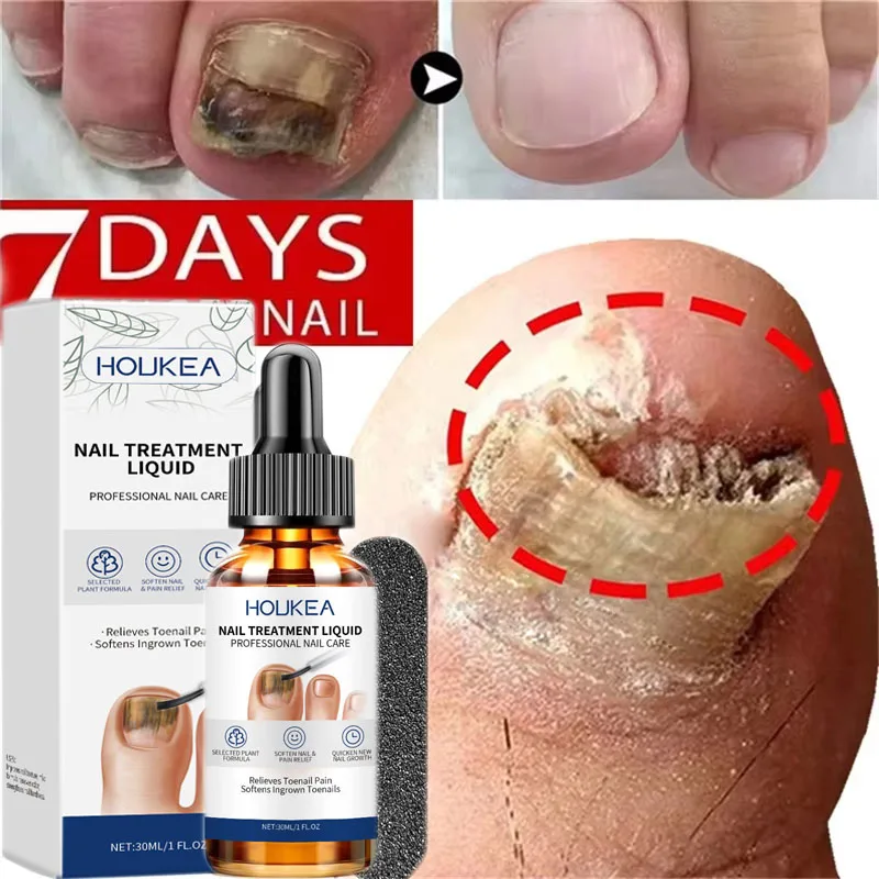 

30ML Nail Fungus Treatment Serum Foot Repair Liquid Toe Nails Fungal Removal Gel Anti Infection Paronychia Onychomycosis Essence