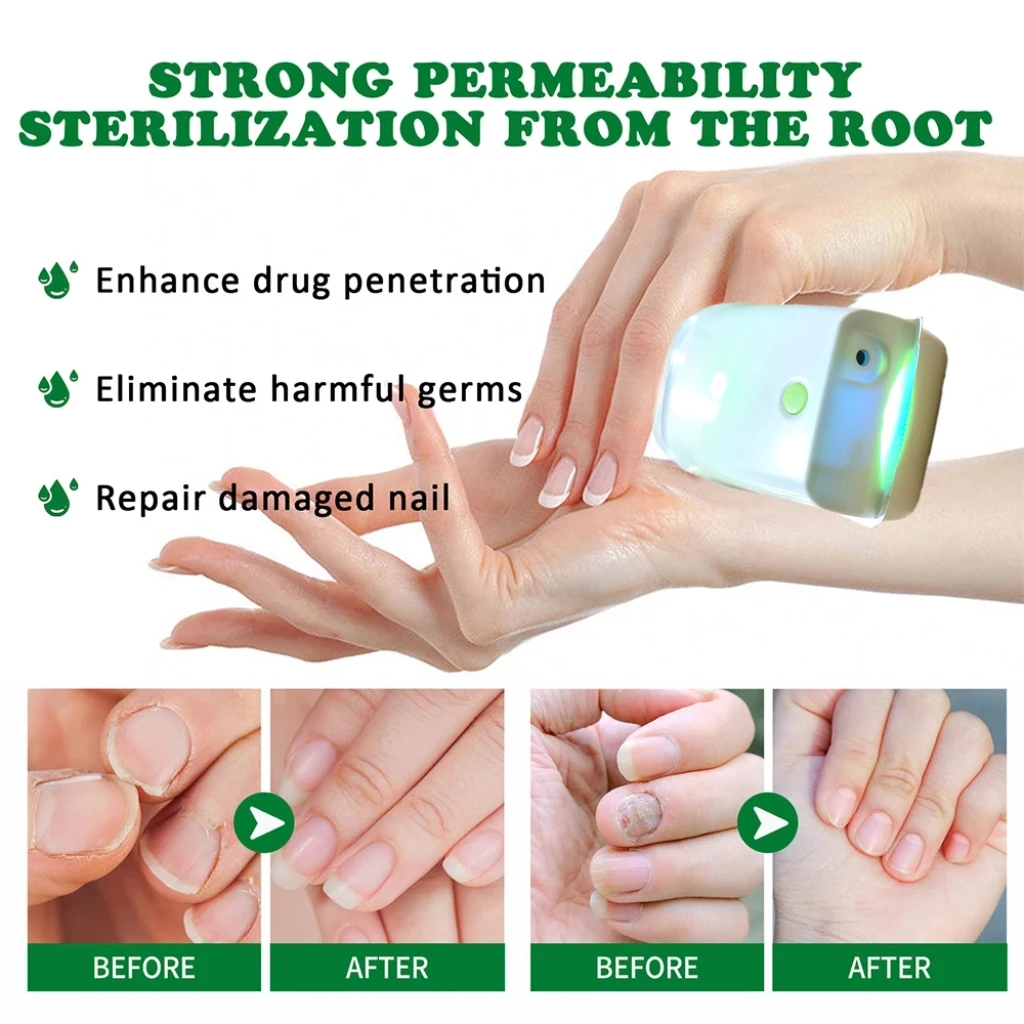 

Professional 905nm Nail Laser Device for Toenail Fungus Treatment, At-Home Onychomycosis Repair Device Fast Results