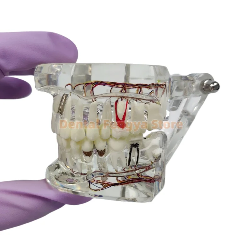 Dental Implant Pathological Teeth Model Teeth Neural Repair Model With Nerves Dental Teaching Study Demonstration Model