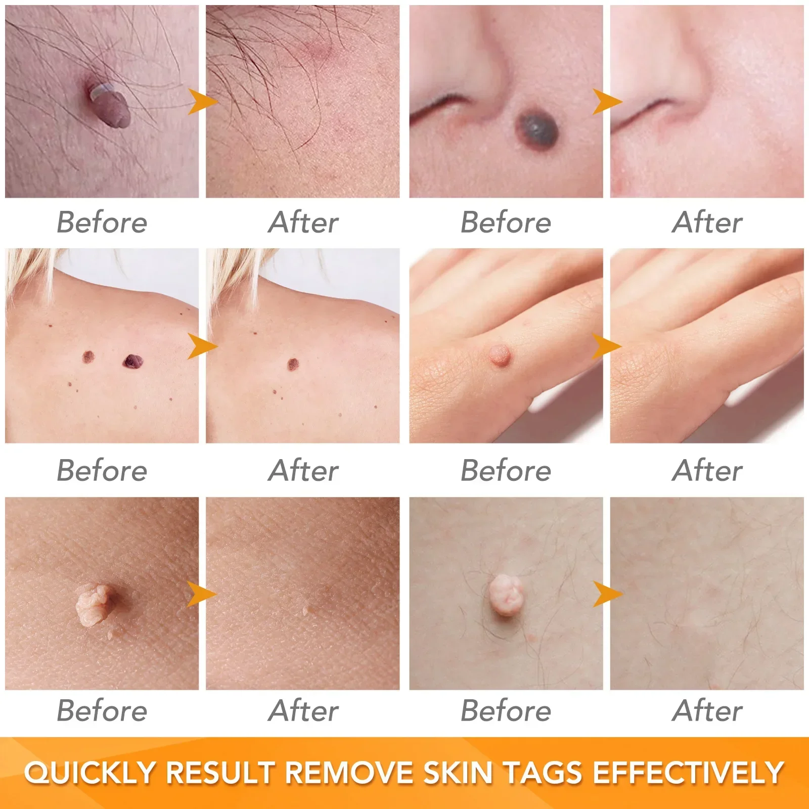 Eenvoudige gereedschapsset voor het verwijderen van wratten Huidtag Verwijderingsgereedschap Gemakkelijk schoon te maken Huidverzorgingshulpmiddel Huidtagverwijdering Verzorgingsproducten