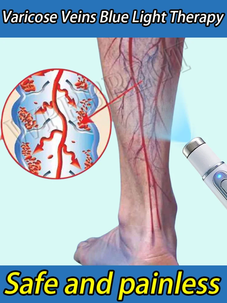 

Nanotechnology upgraded to the second generation to remove varicose veins