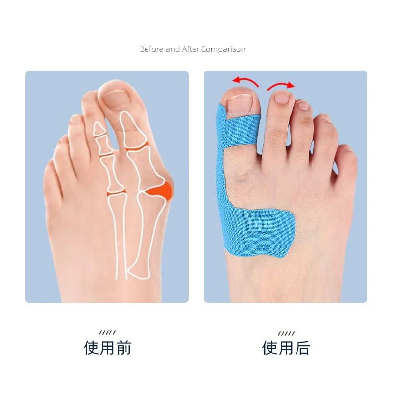 10Pcs Bunion Corrector Orthopedic Bunion Strap Breathable Toe Separator Hallux Valgus Orthosis Corrector for Big Toe Correction