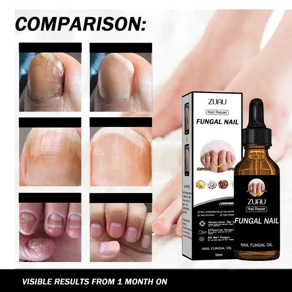 2x Nail Fungals Renewal Nail Repair Liquid for Discolored Thickened Crumbled Nails Nail Fungals for Discolored Broken Cracked