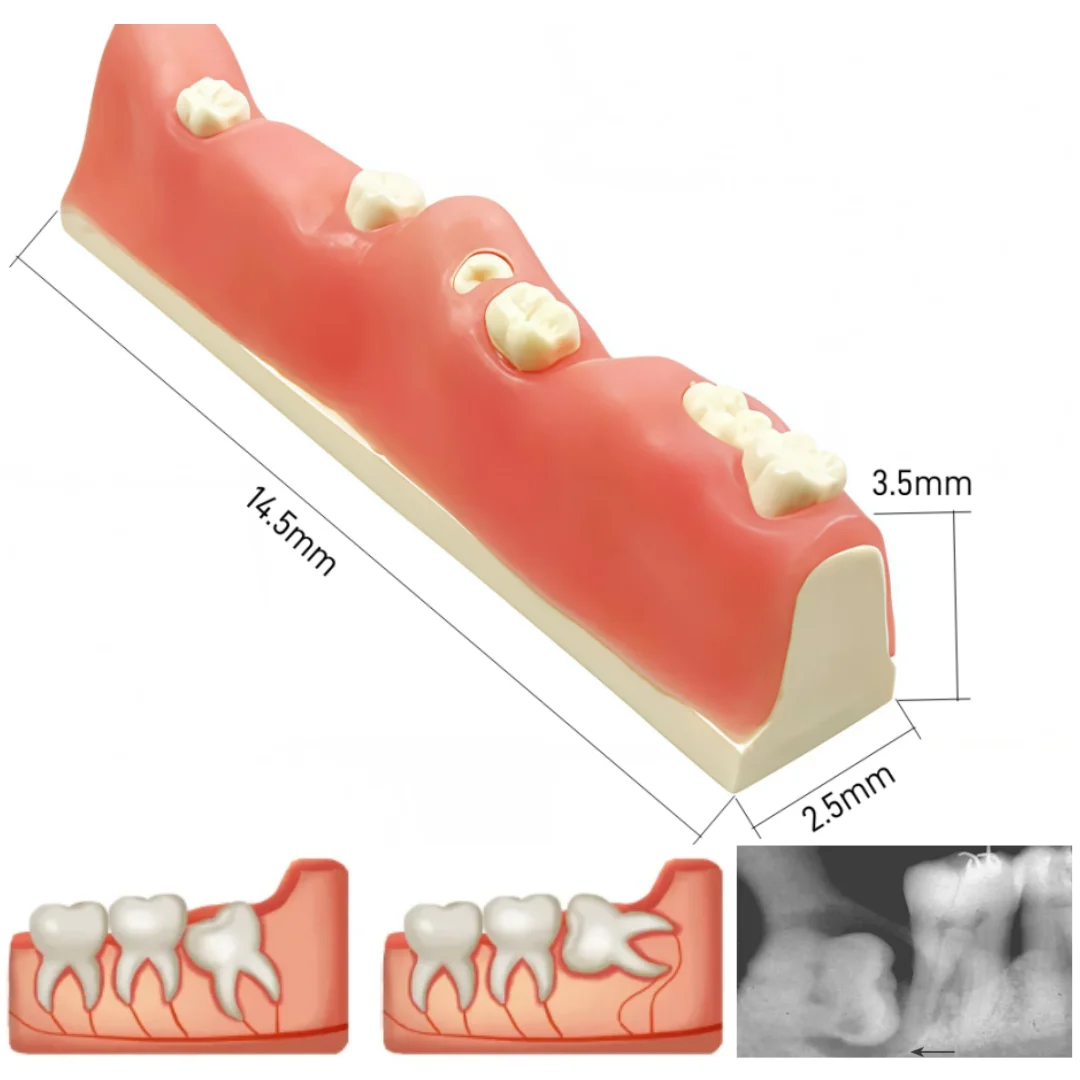 Unerupted Tooth Extraction Practice M8038 Dental Impacted Tooth Model for Operational Training Operational Test Simulation Tool