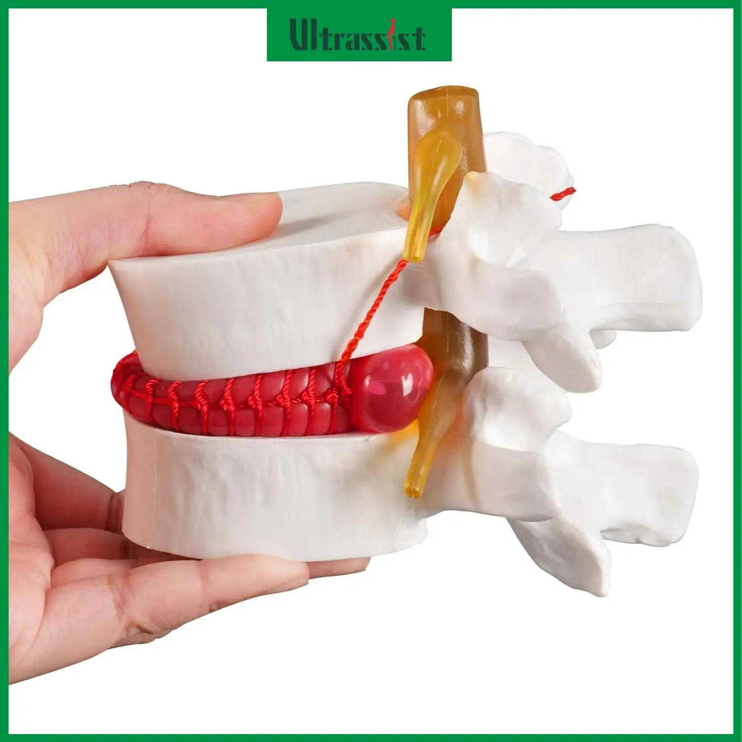 Ultrassist Human Lumbar Disc Herniation Anatomical Model 1.5X Life Size Lumbar Spine Teaching Tool for Medical Student Education