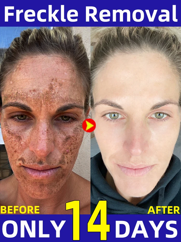 

Sun Age Dark Spot Chloasma Freckles Clear