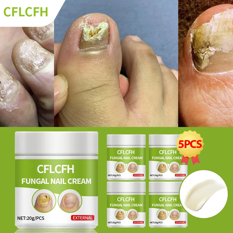 Nail Fungus Treatment Cream Anti Infection Fungal Nail Repair Onychomycosis Removal Paronychia Ingrown Toenail Care Plaster