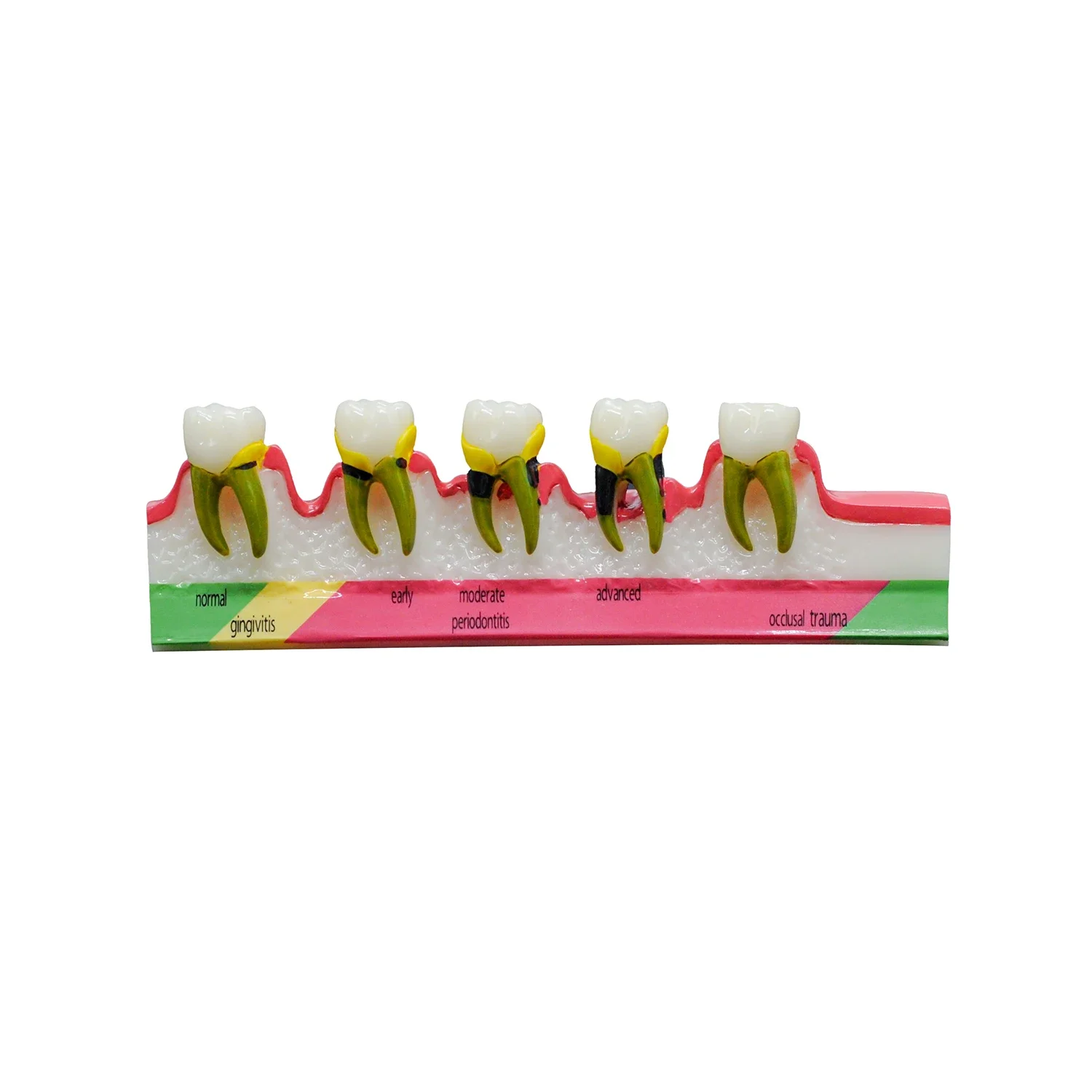 1PC Dental Study Teaching Model Periodontal Disease Assort Teeth Dentoform Typodont for Students Dentists Studying Teaching