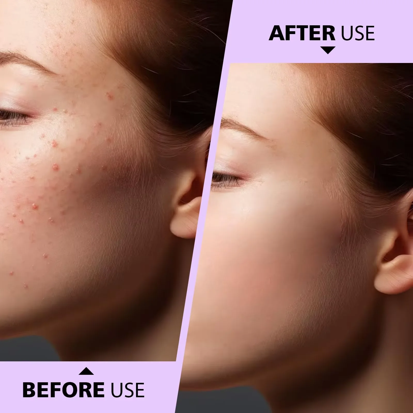 2 قطعة المراهقين بثرة النازع علاج حب الشباب أداة الجراحية الصف البثرة Comedone أداة إزالة الصواميل للوجه الأنف الرؤوس السوداء Extr #3