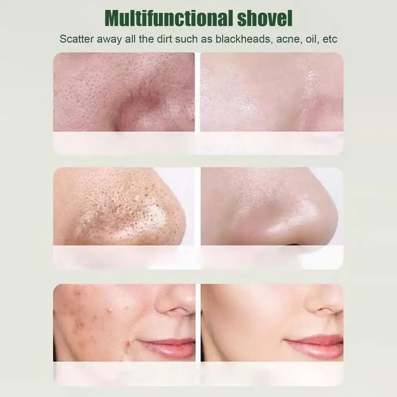 얼굴 여드름 제거 도구 코 딥 클렌징 화이트 헤드 여드름 제거 휴대용 얼굴 주걱 뷰티 삽 추출기