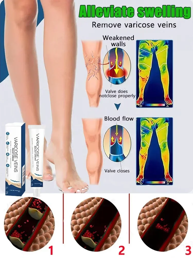 »»»Authentic varicose veins Cream special medical leg veins bulging blood vessel swelling red bloodsilk earthworm leg