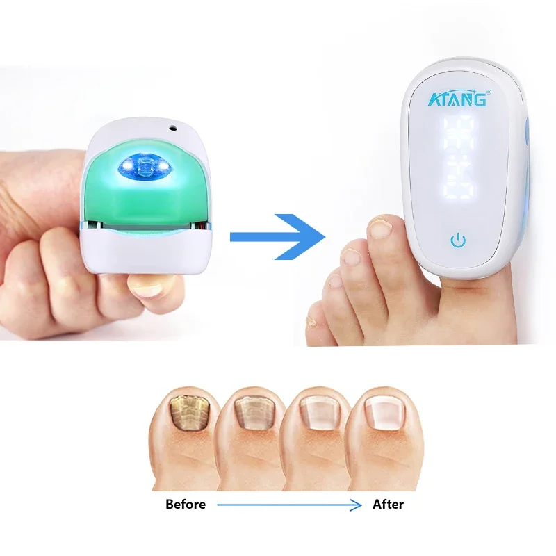 

Medical Physiotherapy Nail Fungus Cleaning Blue Light Therapy Device removal Onychomycosis for Toe Infections