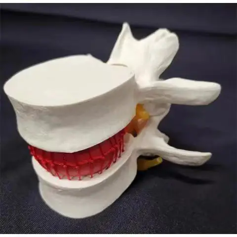 Human lumbar disc herniation model demonstration model of lumbar vertebral spine model PVC material free shipping