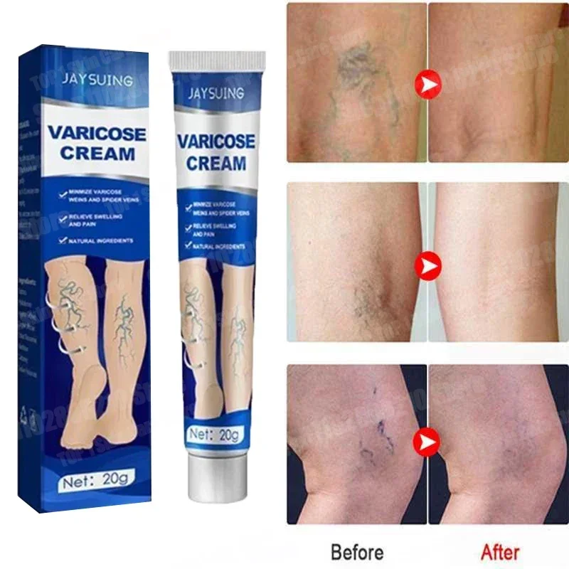 

100% effective varicose veins, effective vasculitis ointment to relieve venous flattening, care for venous ointment