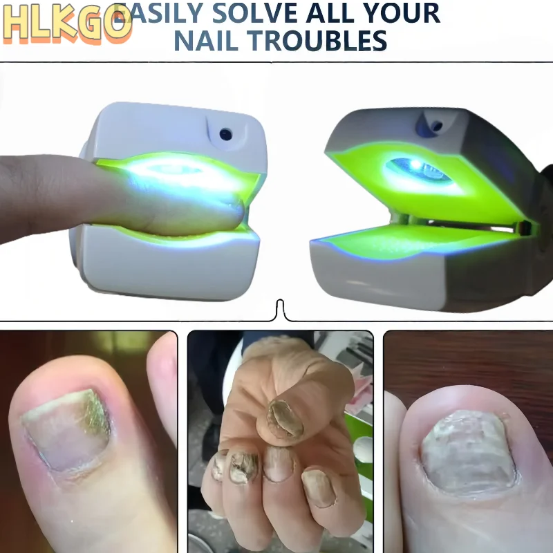 Medical Grade Toenail Fungus Treatment Device for Immediate Repair and Effective Ringworm Elimination