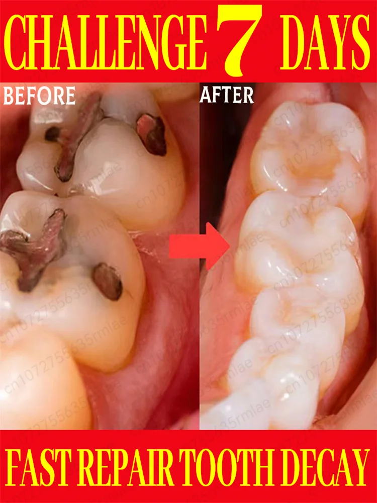 Eliminate tooth decay, quickly heal teeth, and repair periodontal tissue