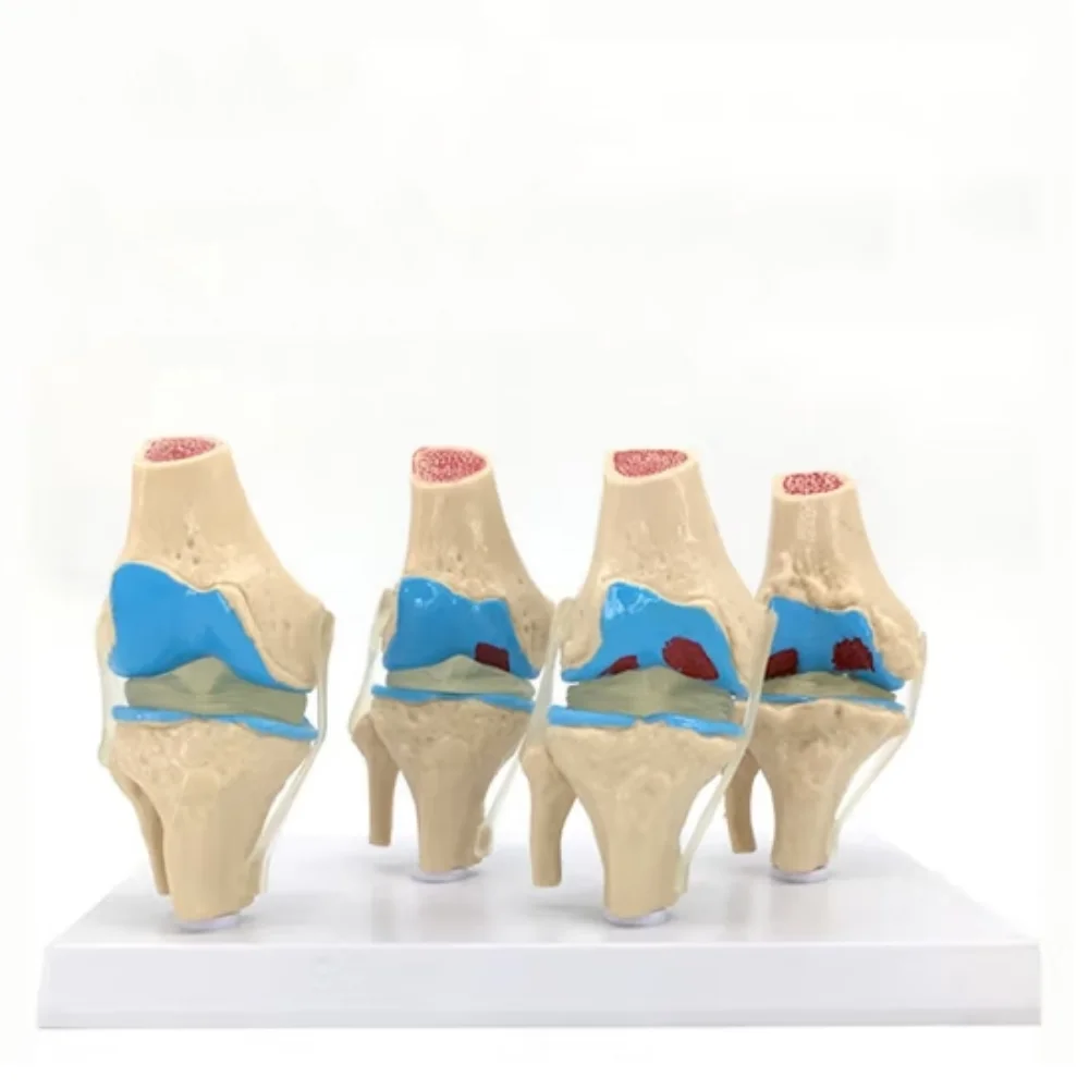 Pathological knee model Four-stage pathological knee model