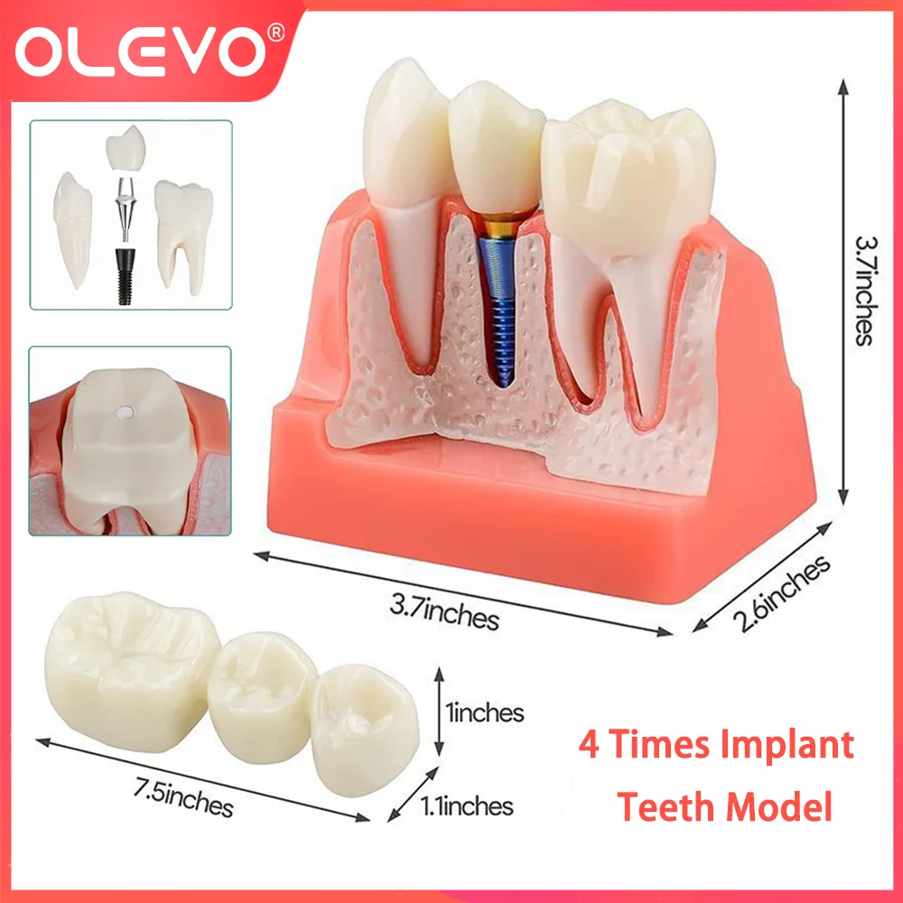 

OLEVO 4 Times Dental Implant Teeth Model Analysis Crown Bridge Demonstration Removable Dentist Teaching Training Student Study