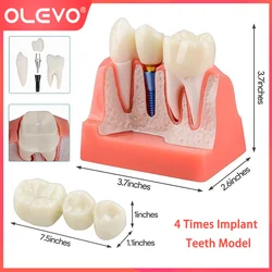 OLEVO 4-krotna analiza Model zębów implantu dentystycznego demonstracja mostka koronowego zdejmowana dentysta nauczająca szkolenie studentów