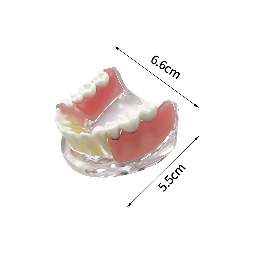 Dental Teeth Model With Implant Overdenture Inferior Demo Mandibular Teeth Model 3 Implants Bridge Dental Teaching Model Dentist